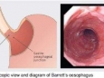 警惕：Barrett食管在确诊后一年内患癌风险最高