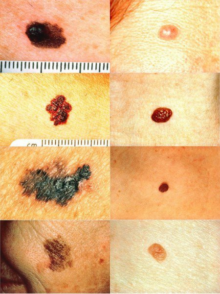 5个小贴士：通过观察痣判断皮肤癌