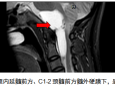 重庆大学附属肿瘤医院神经肿瘤外科完成颅颈交界肠原性囊肿切除术1例