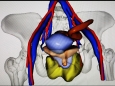 胃肠肿瘤中心开展盆腔横纹肌肉瘤切除术