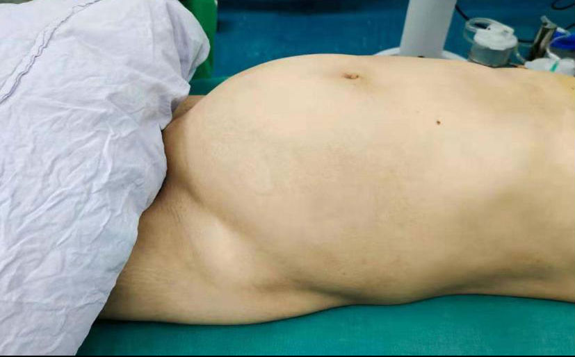 胃肠肿瘤中心成功切除30斤腹腔内巨大肿瘤