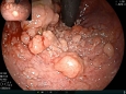 胃肠肿瘤中心为81岁高龄患者实施直肠巨大侧向发育息肉ESD手术