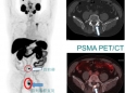 核医学科开展靶向前列腺特异性膜抗原（PSMA） PET/CT肿瘤显像