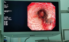 呼吸内镜中心成功开展首例硬质支气管镜下支架植入术