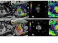 重庆大学附属肿瘤医院影像科张久权团队揭示MRI APT（酰胺质子转移加权成像）定量参数联合血清PSA可鉴别前列腺病变良恶性
